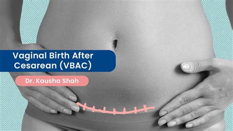 chiaoling sua lao reviews|Success of Vaginal Birth after Cesarean Section (VBAC) based .